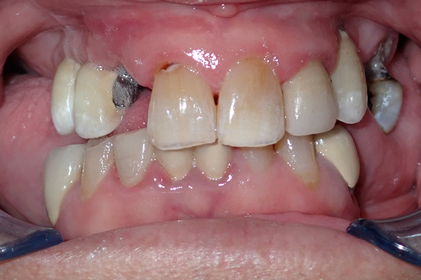 Before