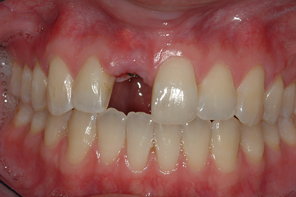 Before