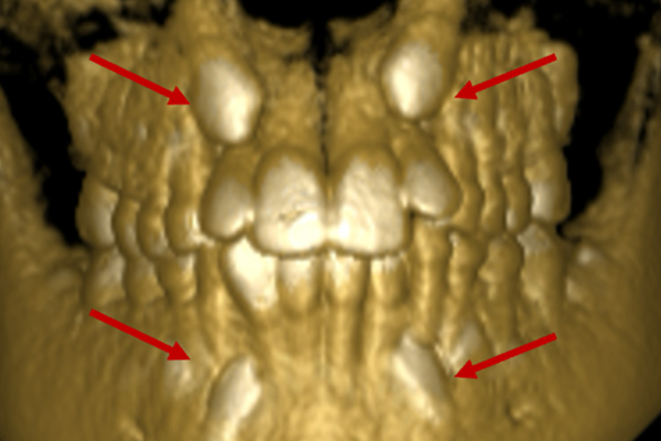 Tooth exposure is a minor surgical procedure performed when a tooth fails to emerge naturally and appears hidden.