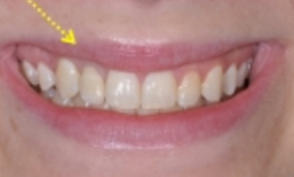 Case 2: Implant #7 with Crown