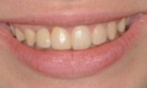 Case 3: Implant #7 with Crown