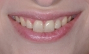 Case 5: Implant #10 with Crown