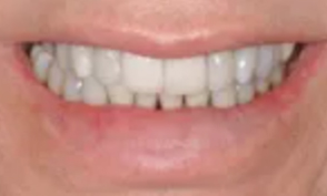 Case 5: Implant #8 with Crown