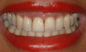 Case 2: Implant #8 with Crown