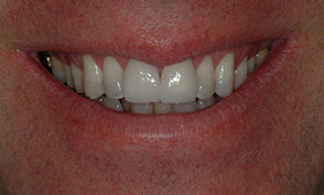 Case 4: Implant #8 with Crown