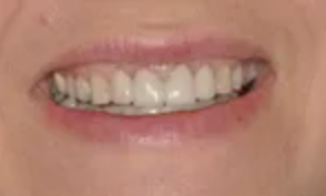 Case 1: Implant #7 with Crown