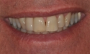 Case 4: Implant #7 with Crown
